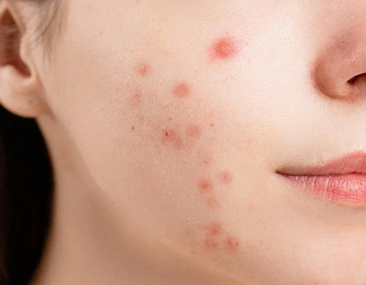 Does Sunscreen Cause Breakouts?