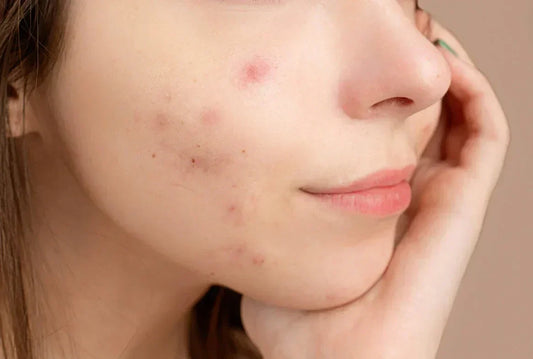 women with Dark Spots and Hyperpigmentation on face